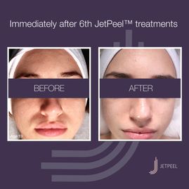 JETPEEL™ BEHANDLUNGEN